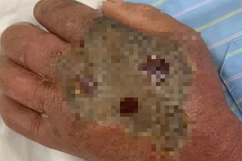 Vào “mùa rắn cắn”, một trường hợp hoại tử bàn tay do tự điều trị