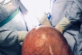 Bác sĩ ngỡ ngàng khi mổ cho bệnh nhân có u tử cung khổng lồ gần 10 kg, bụng như bà bầu