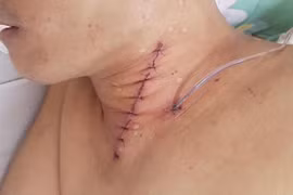 Người đàn ông nguy kịch vì hóc xương gà, một phụ nữ tử vong do hóc thịt trâu