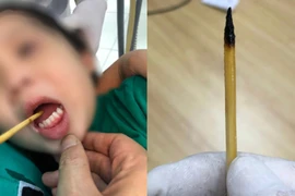 Bé gái 3 tuổi vấp ngã bị chiếc que xiên thịt đâm xuyên qua lưỡi