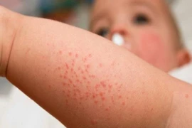 Ghi nhận 2 trường hợp đầu tiên tử vong do sốt xuất huyết trong năm 2022