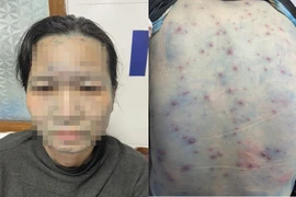 Bệnh nhân thủy đậu gia tăng, ghi nhận nhiều ca biến chứng nặng do mắc bệnh nền