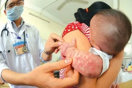 Hà Nội có ca mắc sởi và viêm não Nhật Bản thứ hai trong năm 2024