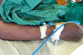 Liên tục uống rượu với lòng lợn và nem chua, nam thanh niên 33 tuổi ở Hà Nội mắc liên cầu khuẩn