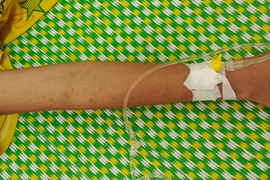 Bé 11 tuổi nhập viện vì chữa bệnh bằng cách rạch tay để nặn máu độc ra ngoài