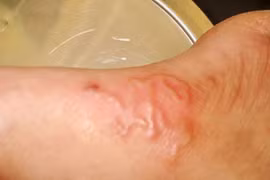 Ăn hải sản sống nguy cơ nhiễm giun lươn