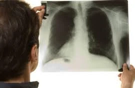 Các yếu tố nguy cơ gây bệnh lao