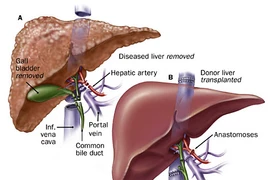 Sàng lọc giúp tăng tỉ lệ sống sót do ung thư gan