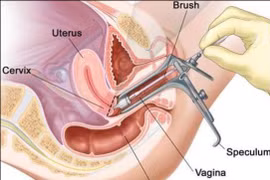 Dấu hiệu cảnh báo ung thư cổ tử cung