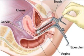 Dấu hiệu cảnh báo ung thư cổ tử cung