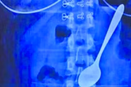 Bị giật mình, nuốt luôn thìa kim loại