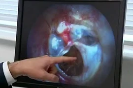 “Vá” màng nhĩ bằng tơ tằm 