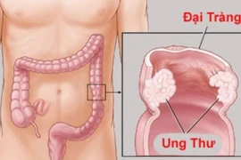 Tìm ra 5 gene liên quan đến ung thư đại tràng