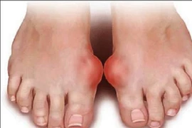 Bệnh gút có thể làm tăng nguy cơ tiểu đường