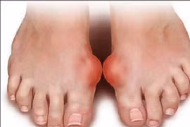 Bệnh gút có thể làm tăng nguy cơ tiểu đường