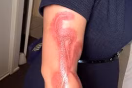 Một phụ nữ bị bỏng nghi do iPhone 7 đang cắm sạc