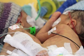 Tách cặp song sinh nhỏ tuổi nhất thế giới