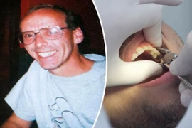 Tử vong sau khi nhổ một lúc 10 cái răng