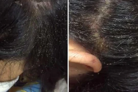 Nổi da gà xem chấy bò lổm ngổm đầy đầu bé gái