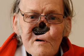 Gương mặt kinh dị sau phẫu thuật