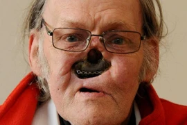 Gương mặt kinh dị sau phẫu thuật