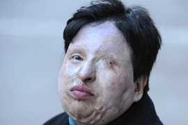 Hình phạt chấn động: Tạt axit vào mắt thủ phạm tấn công bằng axit