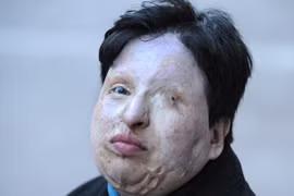 Hình phạt chấn động: Tạt axit vào mắt thủ phạm tấn công bằng axit