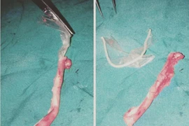 Mổ ruột thừa, tìm thấy bao cao su mắc kẹt trong bụng