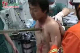 May mắn thoát chết dù bị cọc tre 2m xuyên thấu lồng ngực