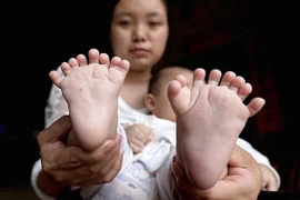 Cha mẹ tuyệt vọng xin giúp đỡ cho con trai có 31 ngón chân, tay