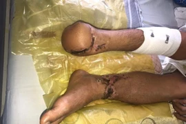 Ngư dân bị đứt lìa 2 bàn chân, sau 18 tiếng vẫn được nối thành công