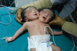 "Bé gái sơ sinh 2 đầu" ở Bangladesh