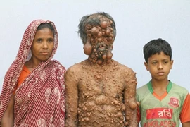 Cuộc sống khổ trăm bề của người đàn ông mọc chi chít khối u