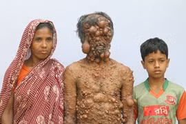 Cuộc sống khổ trăm bề của người đàn ông mọc chi chít khối u