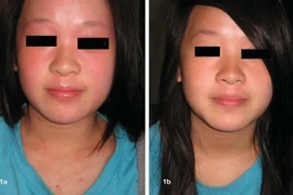 Chữa viêm da dị ứng ở trẻ bằng thảo dược