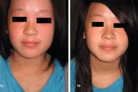 Chữa viêm da dị ứng ở trẻ bằng thảo dược