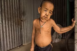 Cha mẹ bất lực nhìn con trai 4 tuổi già như ông cụ 80 tuổi 