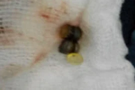 Cứu sống bé 14 tháng tuổi bị tắc ruột do nuốt phải dị vật