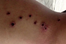 Dùng súng hoa cải bắn người thủng chi chít