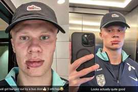 Haaland phải khâu 3 mũi ở miệng vì tai nạn hy hữu