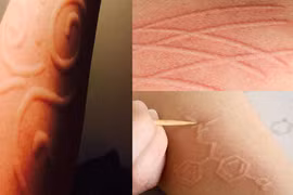 [ẢNH] Kỳ lạ chứng da vẽ nổi xuất hiện trên cơ thể con người 