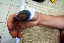 Hái nắm mùng tơi, bị hàng xóm cắn đứt ngón tay cái