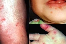 Sớm dập ổ dịch tay chân miệng
