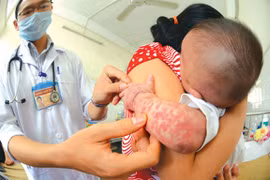 Nỗ lực khống chế dịch sởi bùng phát tại Hòa Bình