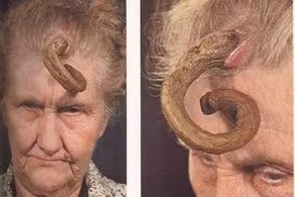 "Bí ẩn" những chiếc sừng mọc trên...đầu người