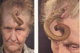 "Bí ẩn" những chiếc sừng mọc trên...đầu người