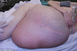 Cắt bỏ khối u nặng 36 kg trong dạ dày người phụ nữ