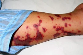 Dịp Tết, cảnh giác cao với viêm não mô cầu