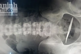 Nam thanh niên nuốt kẹp sắt dài 12cm vào bụng