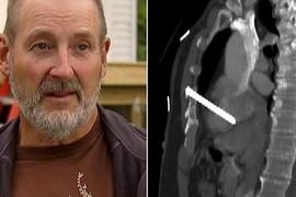 Người thợ mộc sống sót kì diệu sau khi bị đinh bắn vào tim